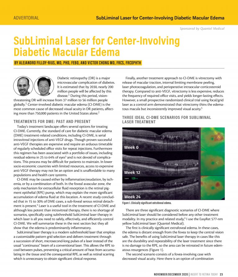 SubLiminal Laser for Center-Involving Diabetic Macular Edema