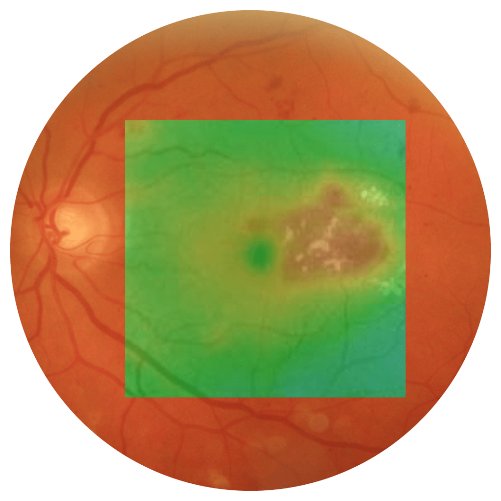 Retina after Subliminal Laser Therapy