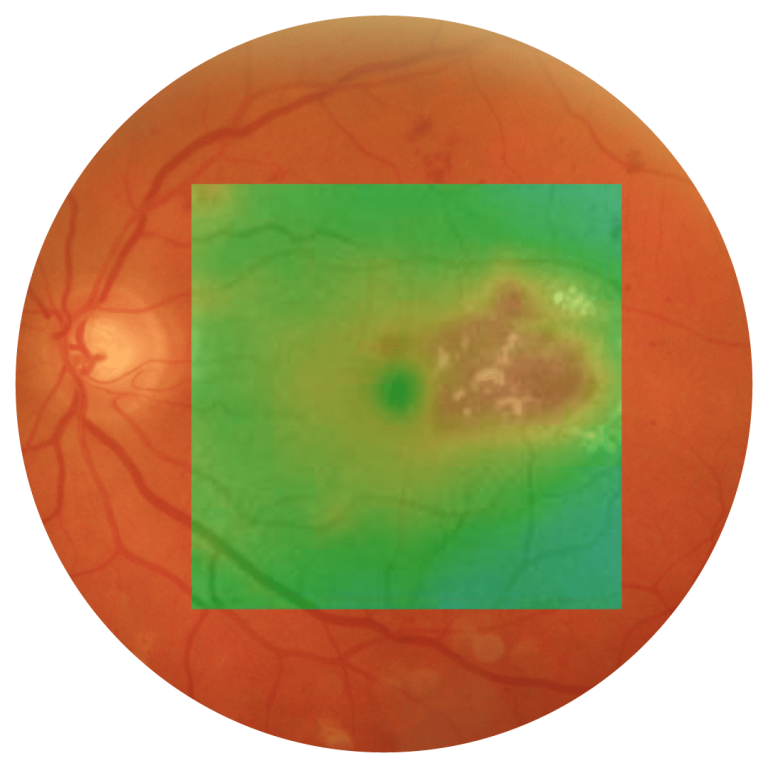 retina image subliminal laser therapy treatment