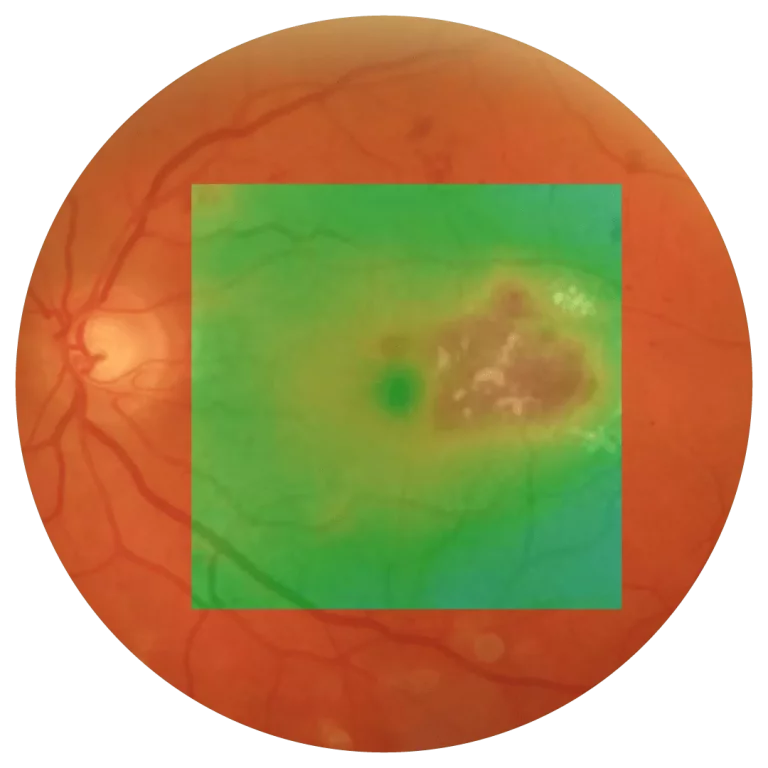 retina image subliminal laser therapy treatment