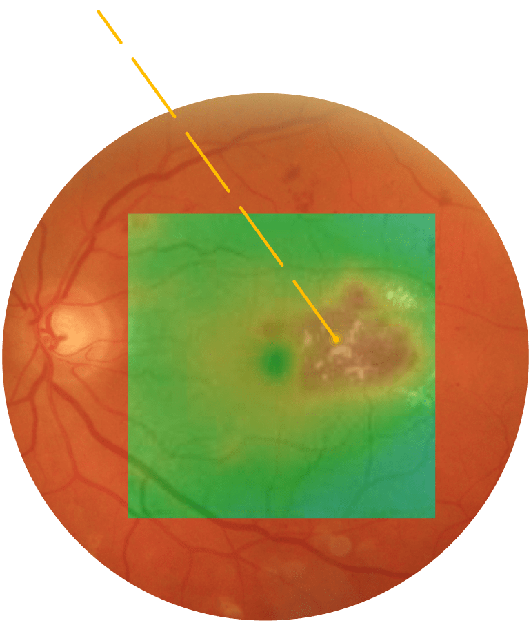 Terapia con Láser SubLiminal - Tratamiento macular 1 Aplicación de la terapia láser subliminal en la mácula.