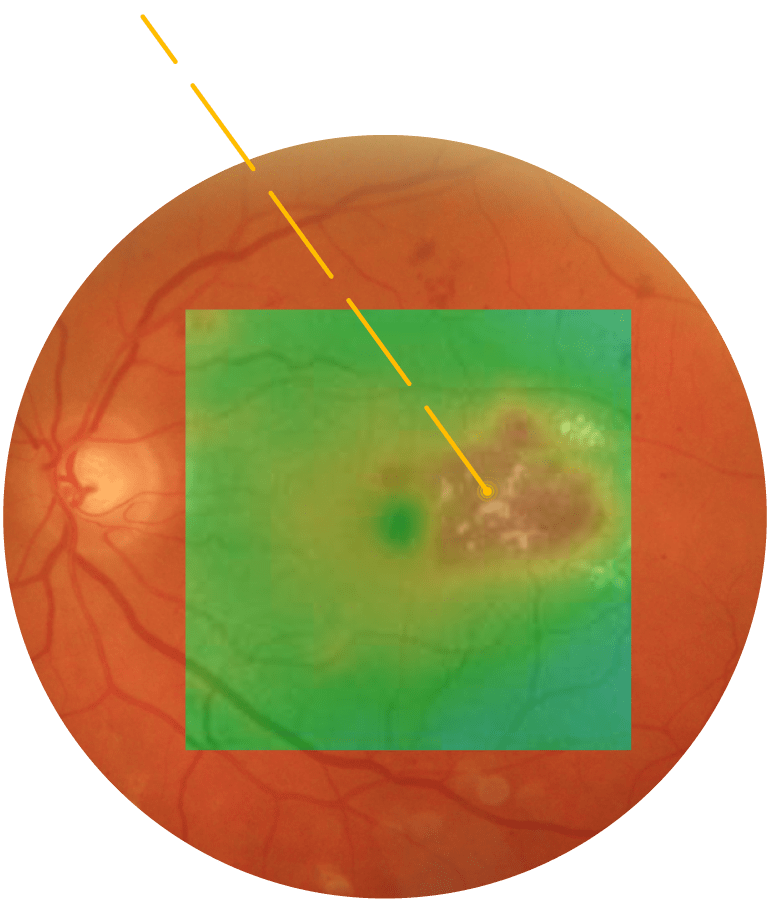 Zastosowanie laseroterapii podprogowej na plamce żółtej