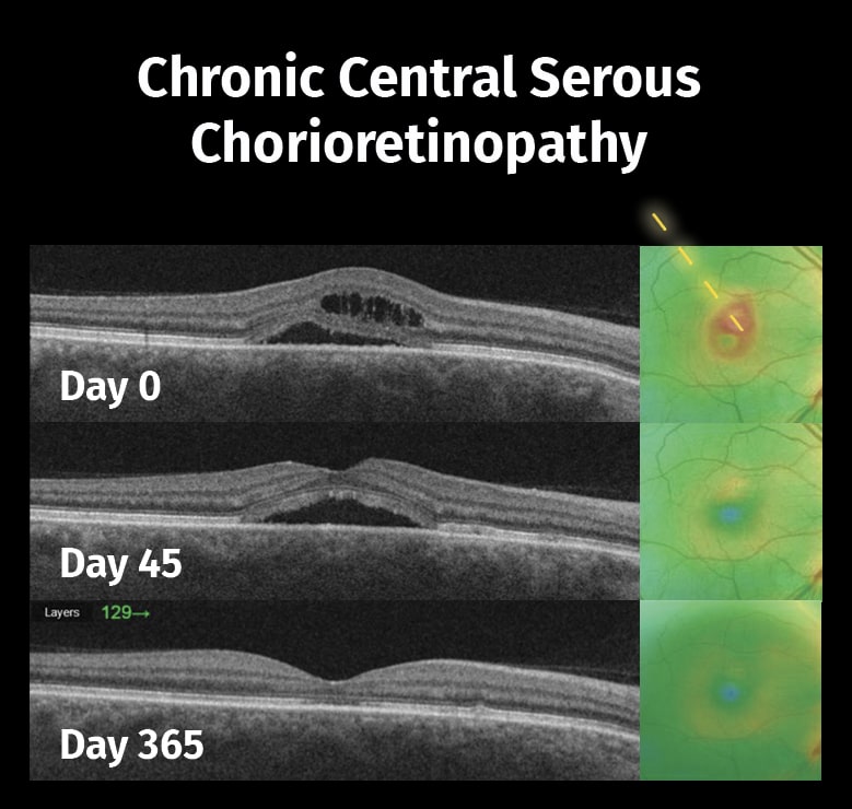 Terapia con Láser SubLiminal - Tratamiento macular 5 Coriorretinopatía Serosa Central
