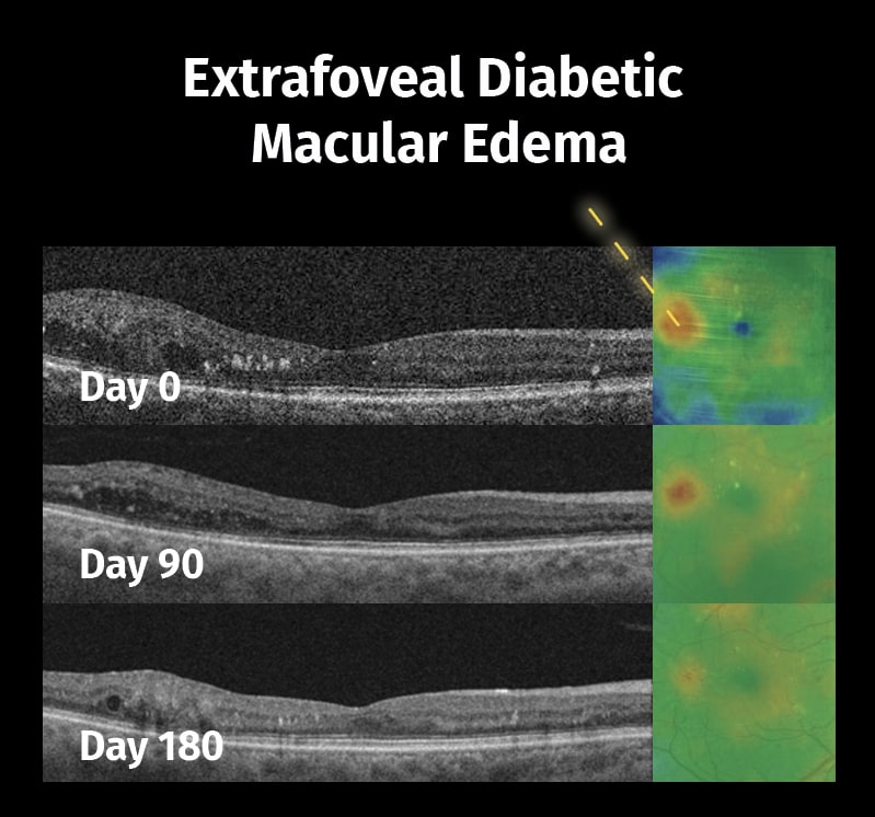 Extrafoveal diabetic macular edema