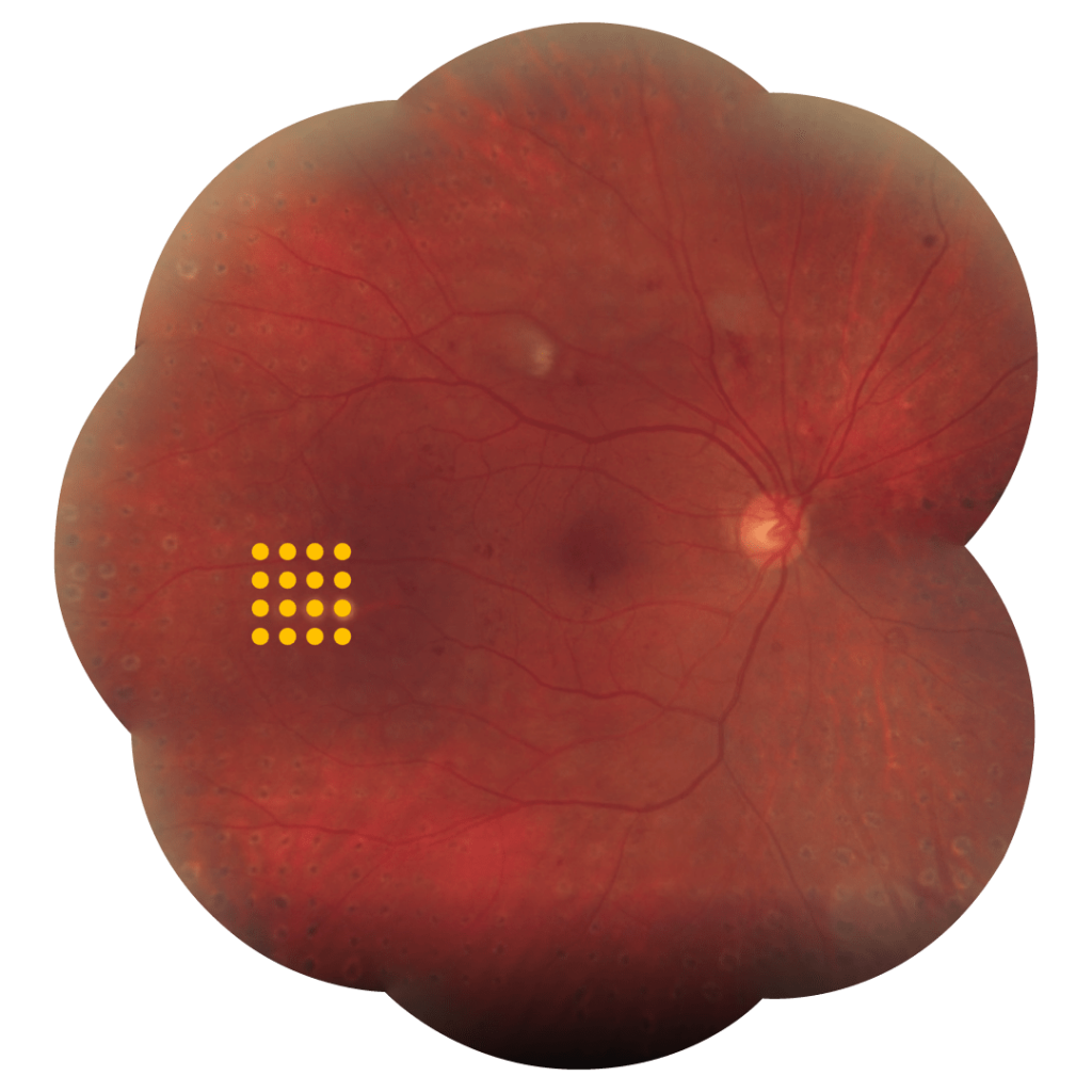 Multispot treatment on periphery