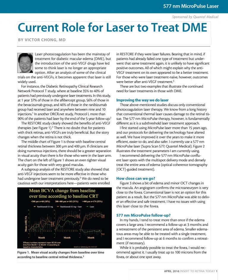 Current Role for Laser to Treat DME
