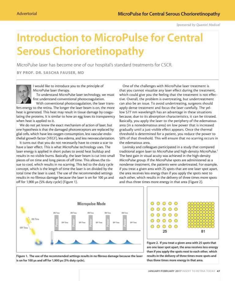Introduction to MicroPulse for Central Serous Chorioretinopathy