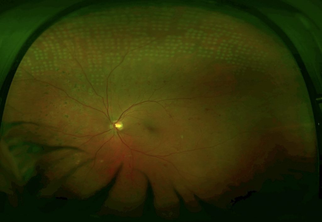 Peripheral treatment - Clinical data PRP