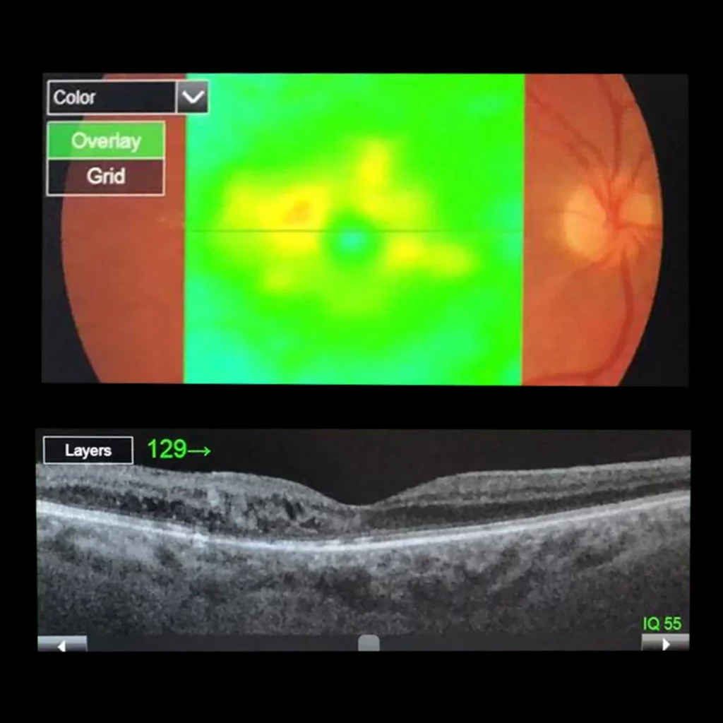 combination-of-577nm-subliminal-laser-and-577nm-focal-laser-after