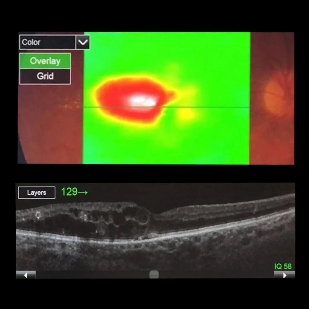 Subliminal Laser Therapy - A Macular Treatment 6 combination-of-577nm-subliminal-laser-and-577nm-focal-laser-before