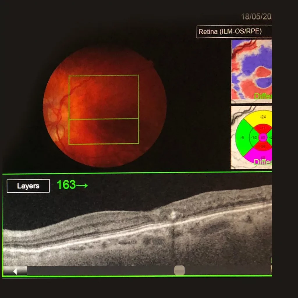 Subliminal Laser Therapy - A Macular Treatment 5 macular-telangiectasia-after