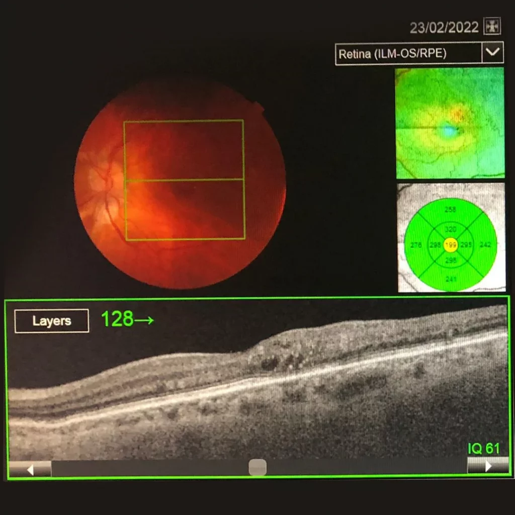 Subliminal Laser Therapy - A Macular Treatment 4 macular-telangiectasia-before