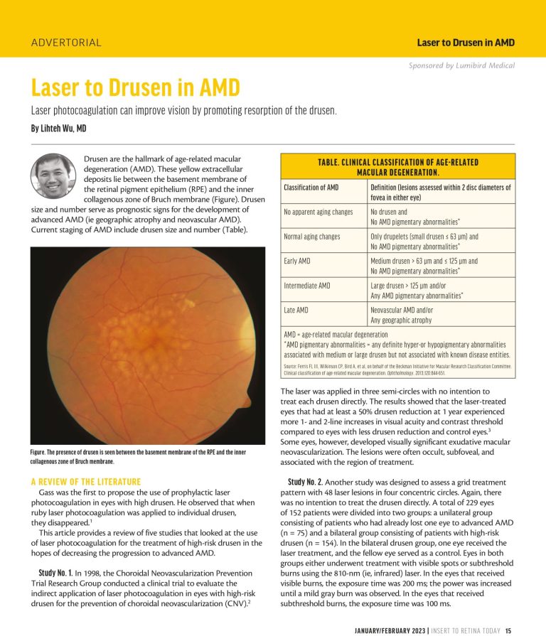 Laser photocoagulation can improve vision by promoting resorption of the drusen.