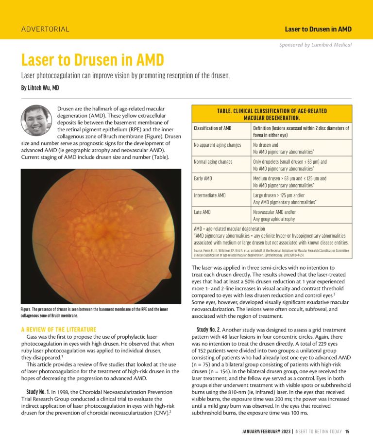 LECZENIE LASEROWE TECHNIKĄ SUBLIMINAL: LECZENIE PLAMKI ŻÓŁTEJ 8 Laser photocoagulation can improve vision by promoting resorption of the drusen.